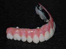 Hybrid Teeth