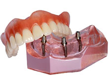 Implant Supported Denture