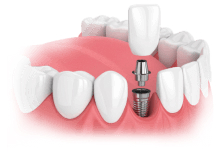 Single Dental Implant