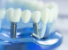 Multiple Dental Implants